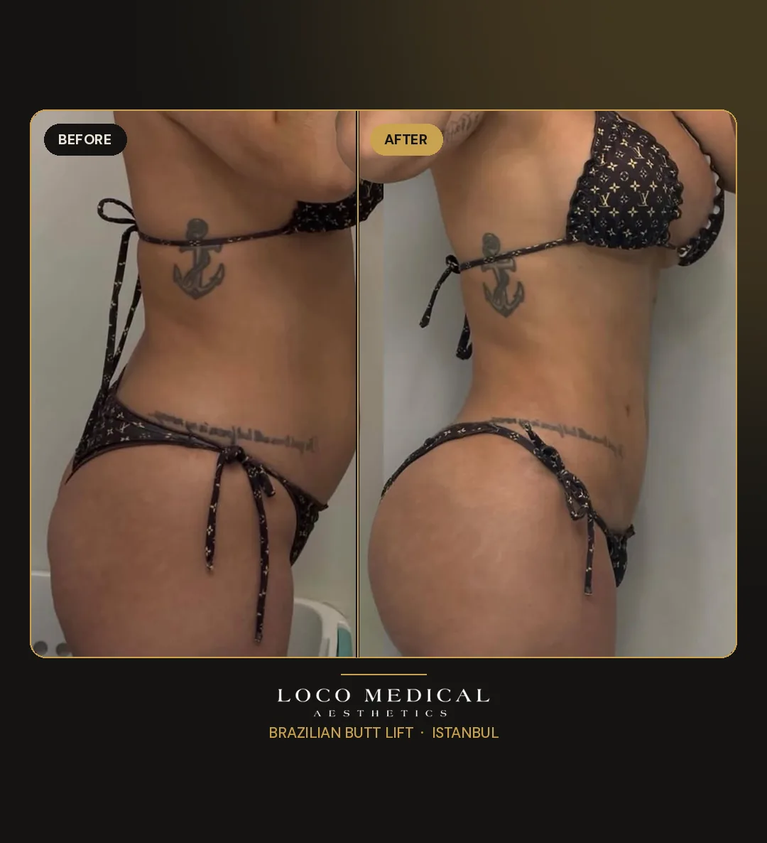 Brazilian Butt Lift before and after — Loco Medical patient 1