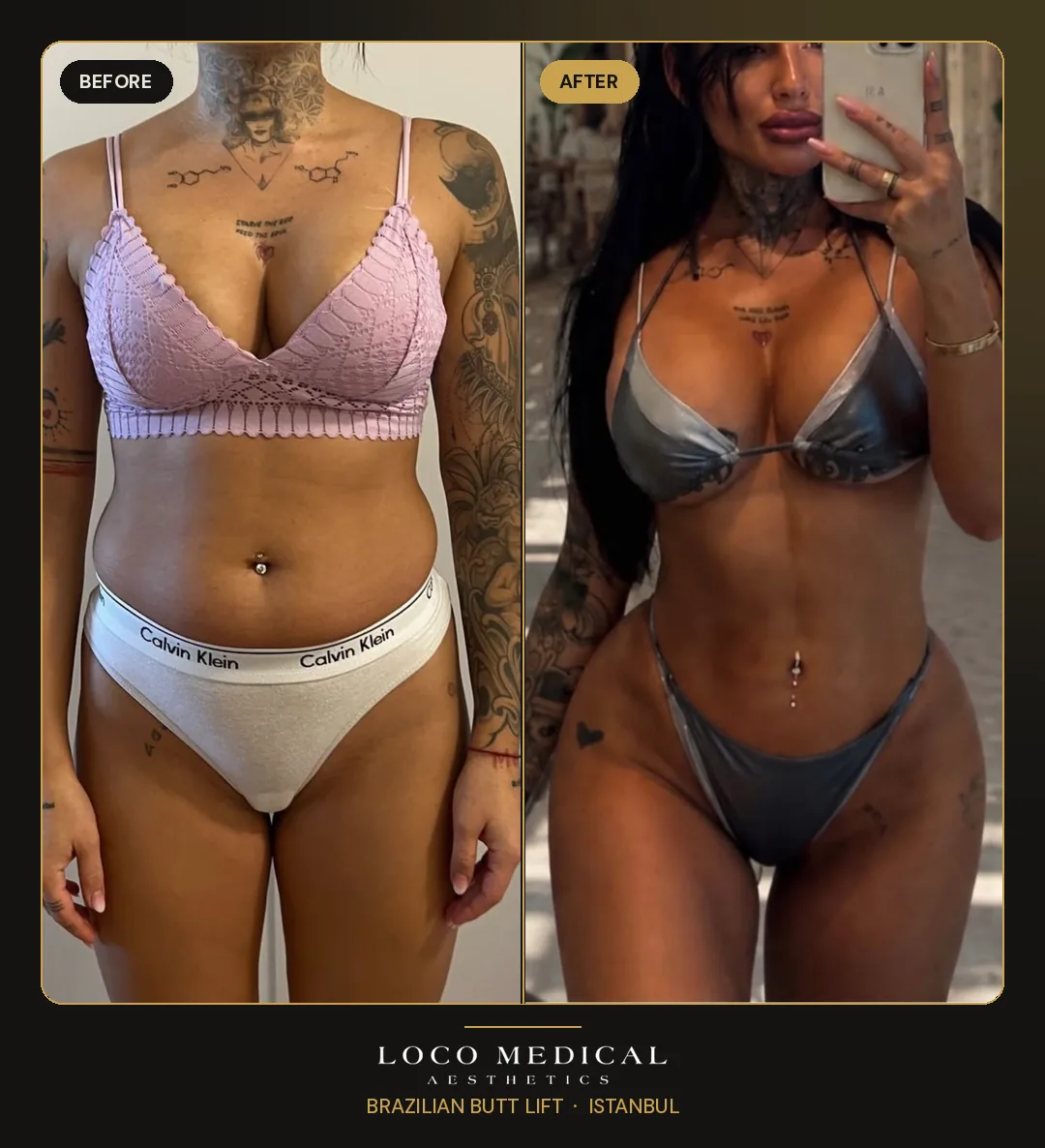 Brazilian Butt Lift before and after — Loco Medical patient 3