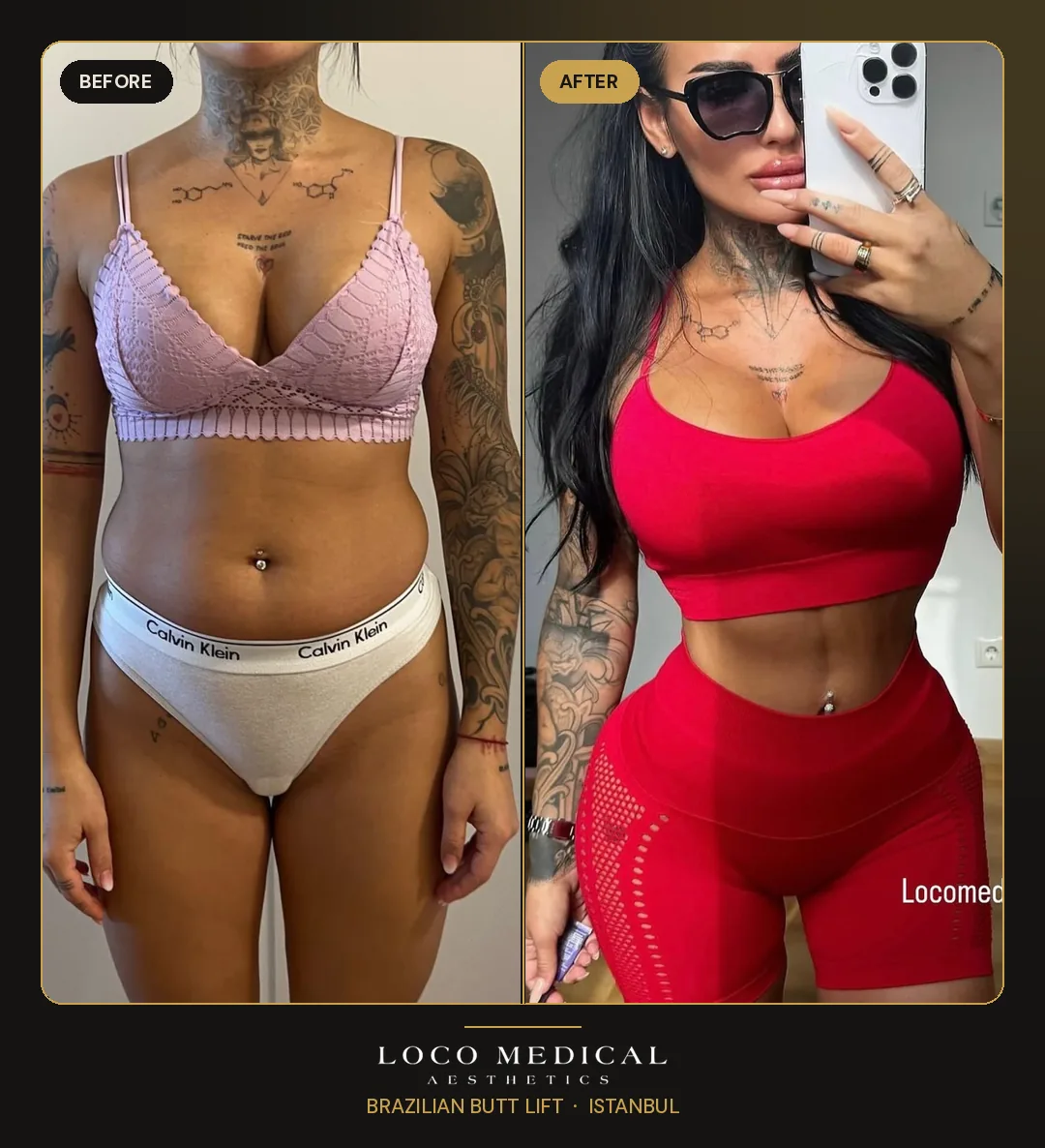 Brazilian Butt Lift before and after — Loco Medical patient 4