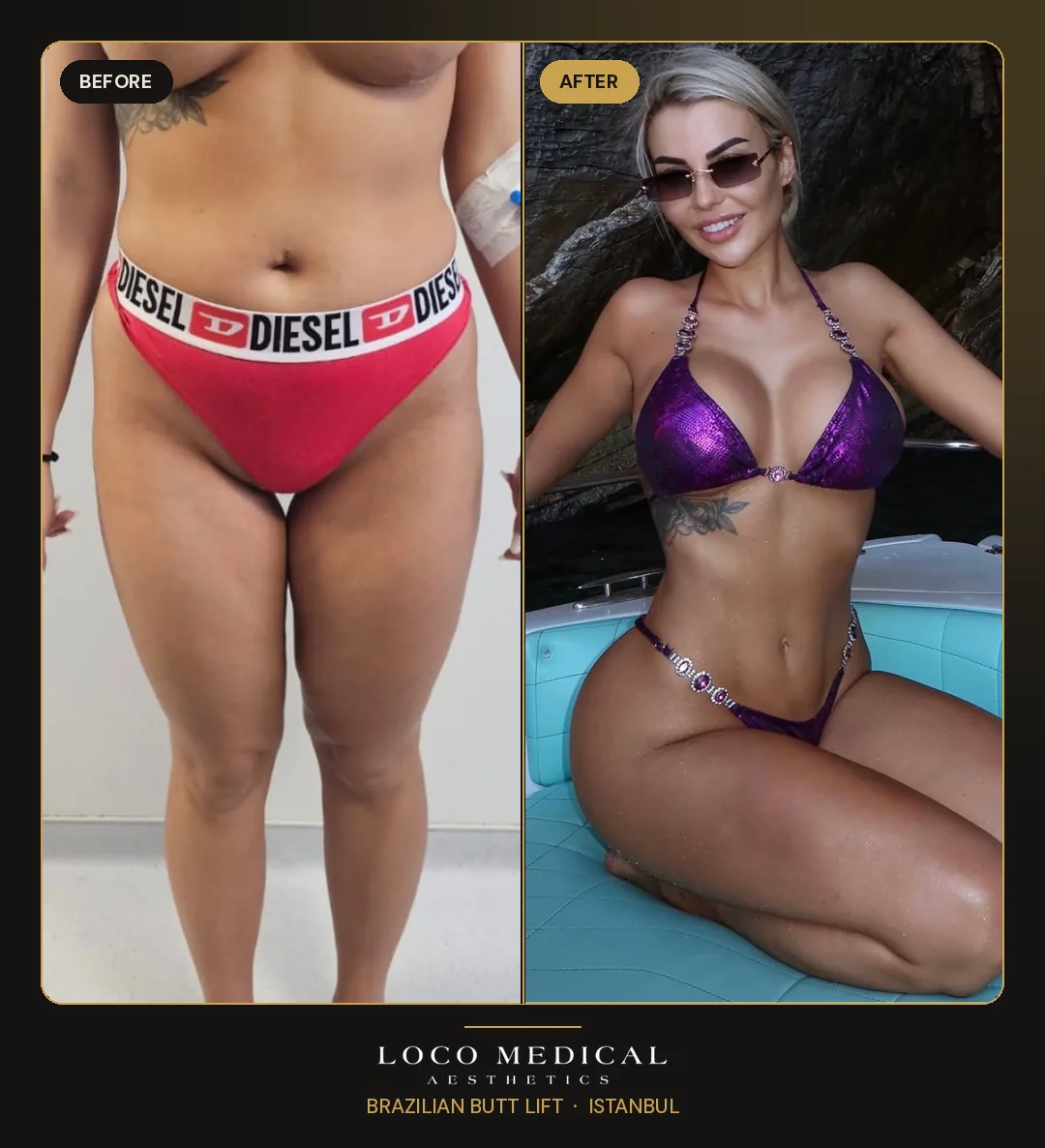 Brazilian Butt Lift before and after — Loco Medical patient 5