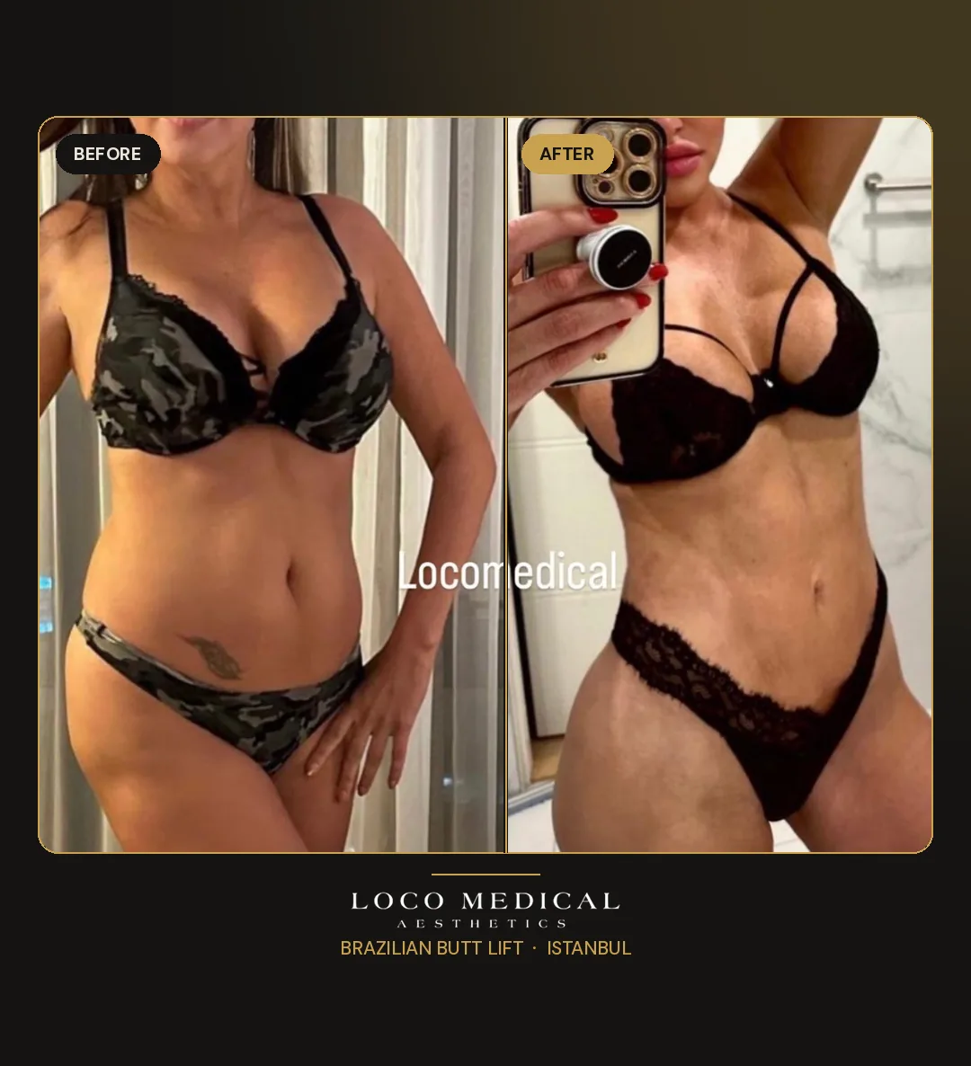 Brazilian Butt Lift before and after — Loco Medical patient 6