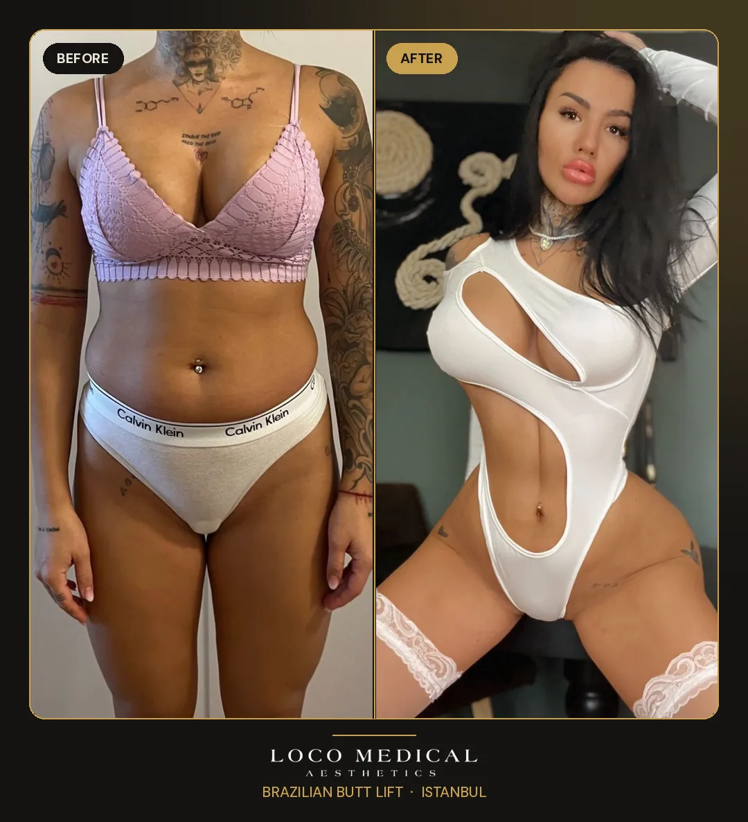 Brazilian Butt Lift before and after — Loco Medical patient 7