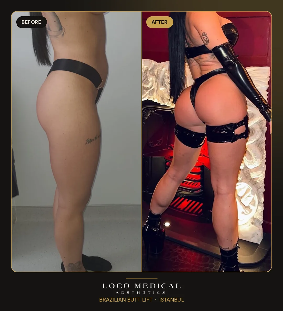 Brazilian Butt Lift before and after — Loco Medical patient 8